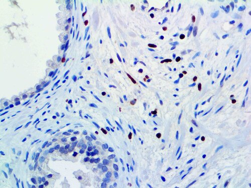 IHC of c-Myc on an FFPE Prostatic Adenocarcinoma Tissue